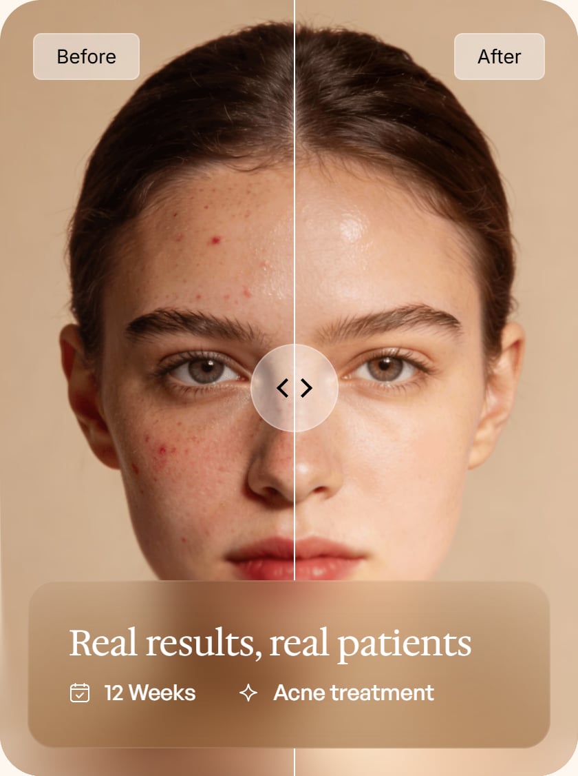 Before and after acne treatment comparison — real results, real patients, 12 weeks of acne treatment